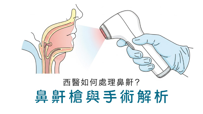 鼻鼾槍原理剖面圖：鐳射能量加熱軟顎組織收縮，改善氣道阻塞與睡眠窒息症